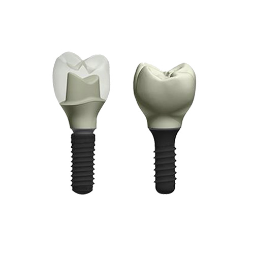 Phục hình răng trên Implant